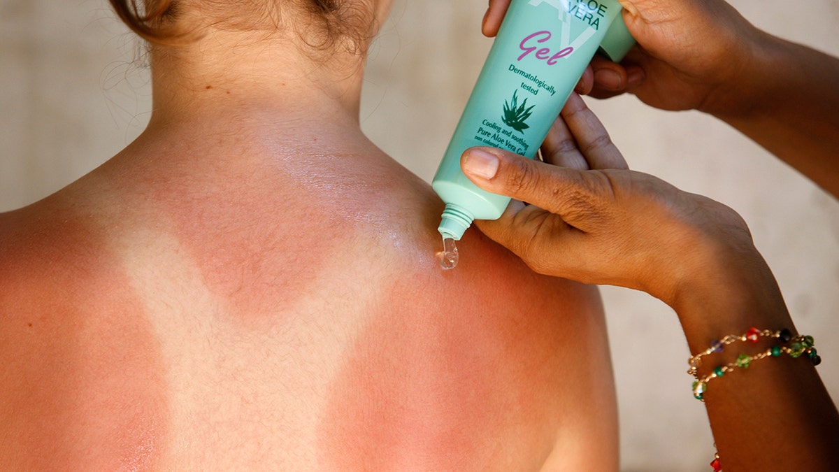 Aloe vera being applied to a sunburn