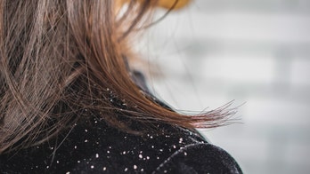 How to get rid of dandruff: Scalp experts share treatment tips and potential causes