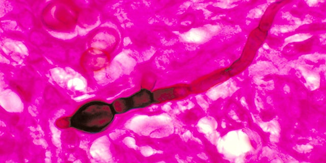 Blastomyces Dermatitidis