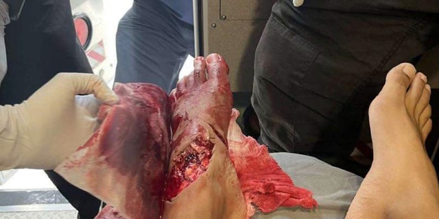 Foot injured from shark bite