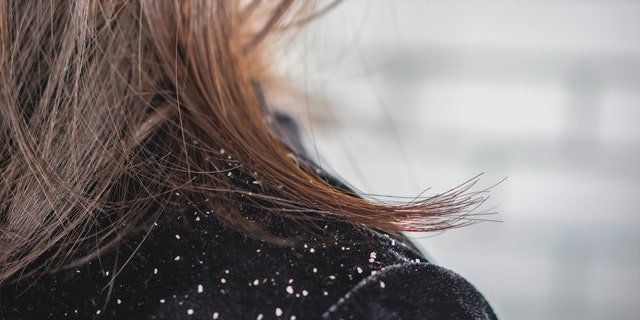 Woman with dandruff on shoulder.