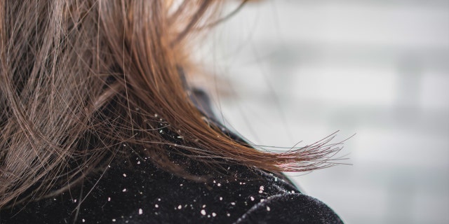 Woman with dandruff on shoulder.