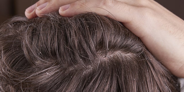 Dandruff up close on scalp with parted hair.