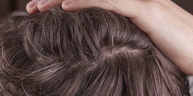 Caspa de cerca en el cuero cabelludo con el pelo dividido.