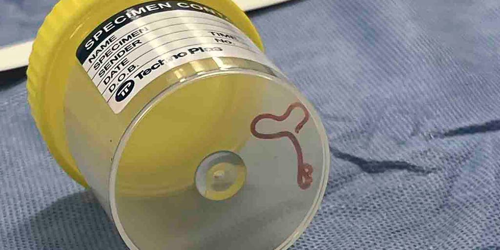 Australian neurosurgeon finds parasitic worm in woman's brain while investigating 'mystery illness' - Vimarsana News