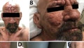 Lepromatous leprosy in a 54-year-old man in central Florida in 2022
