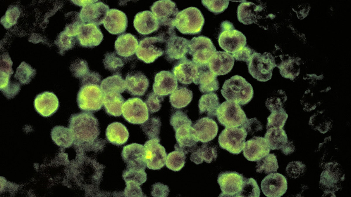 Photomicrograph of amebic meningoencephalitis