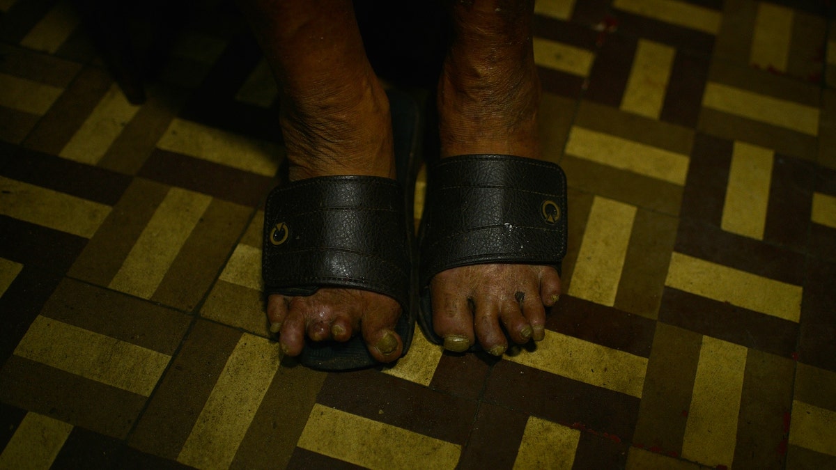 A Brazil man's feet show impacts of leprosy