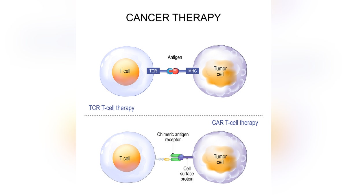 CAR T-cell therapy