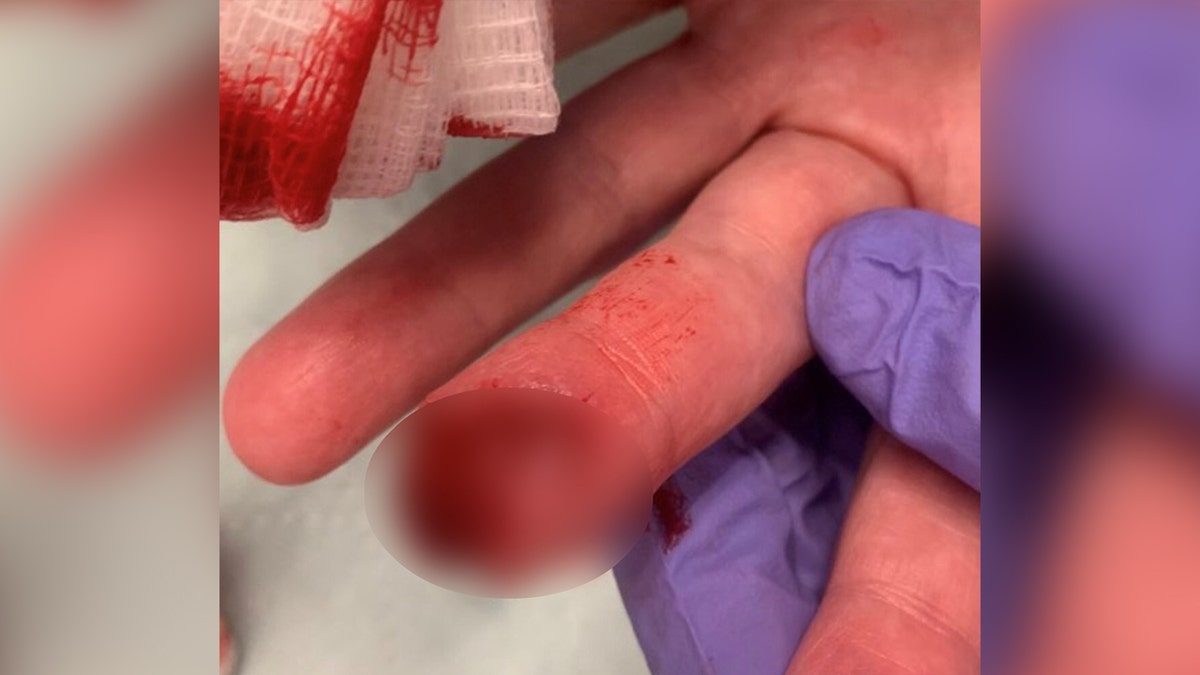 Heverly's bleeding finger