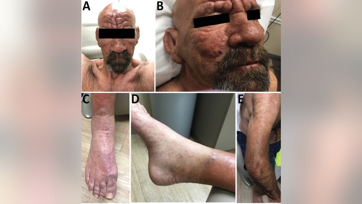 A central Florida man with leprosy