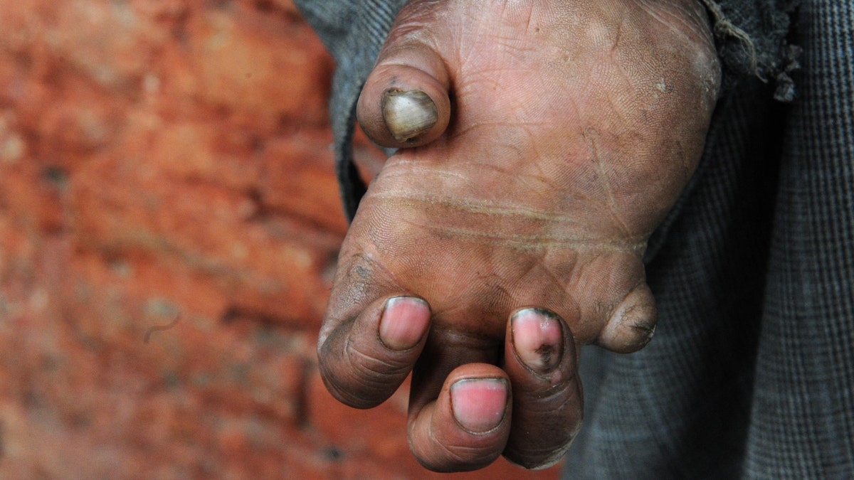 A leprosy patient holds out his hand in India