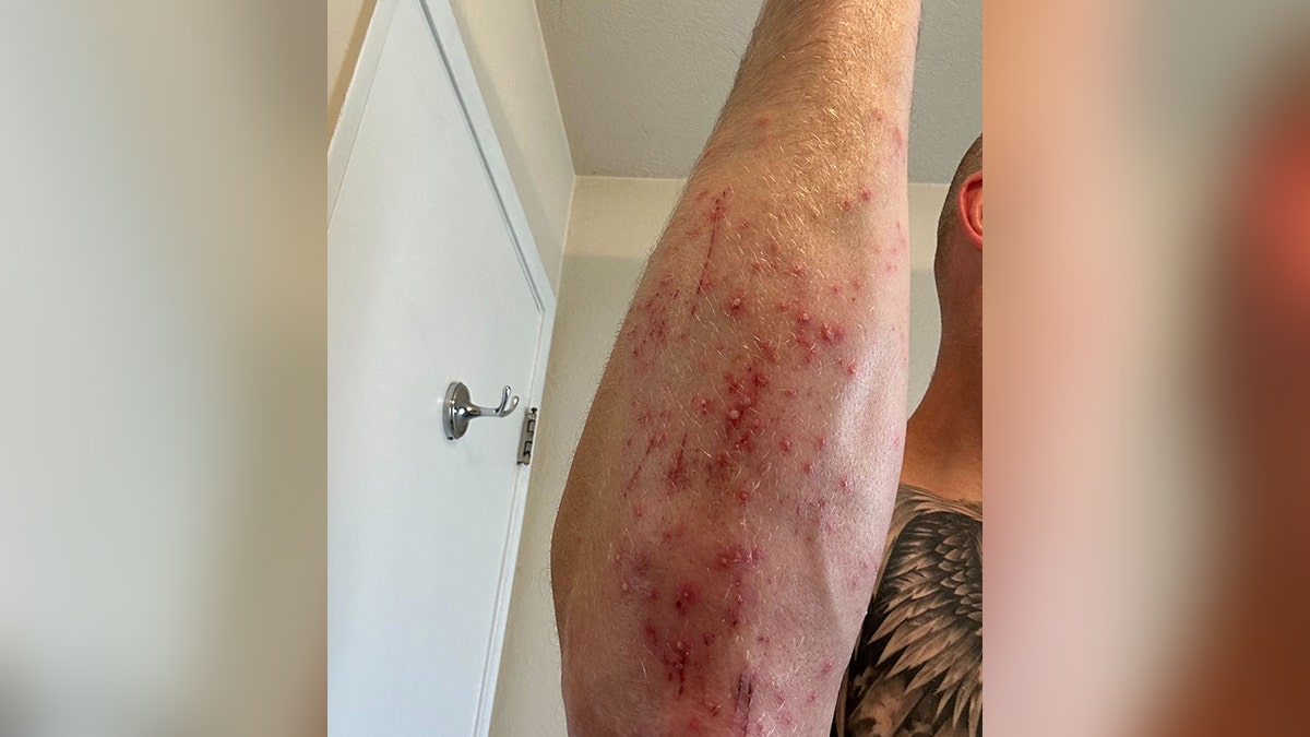 Man's arm covered in a rash