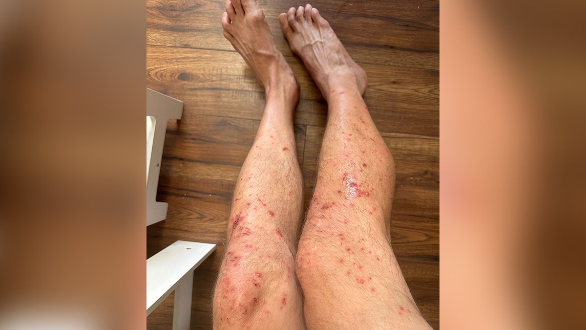 Man's legs covered in a rash