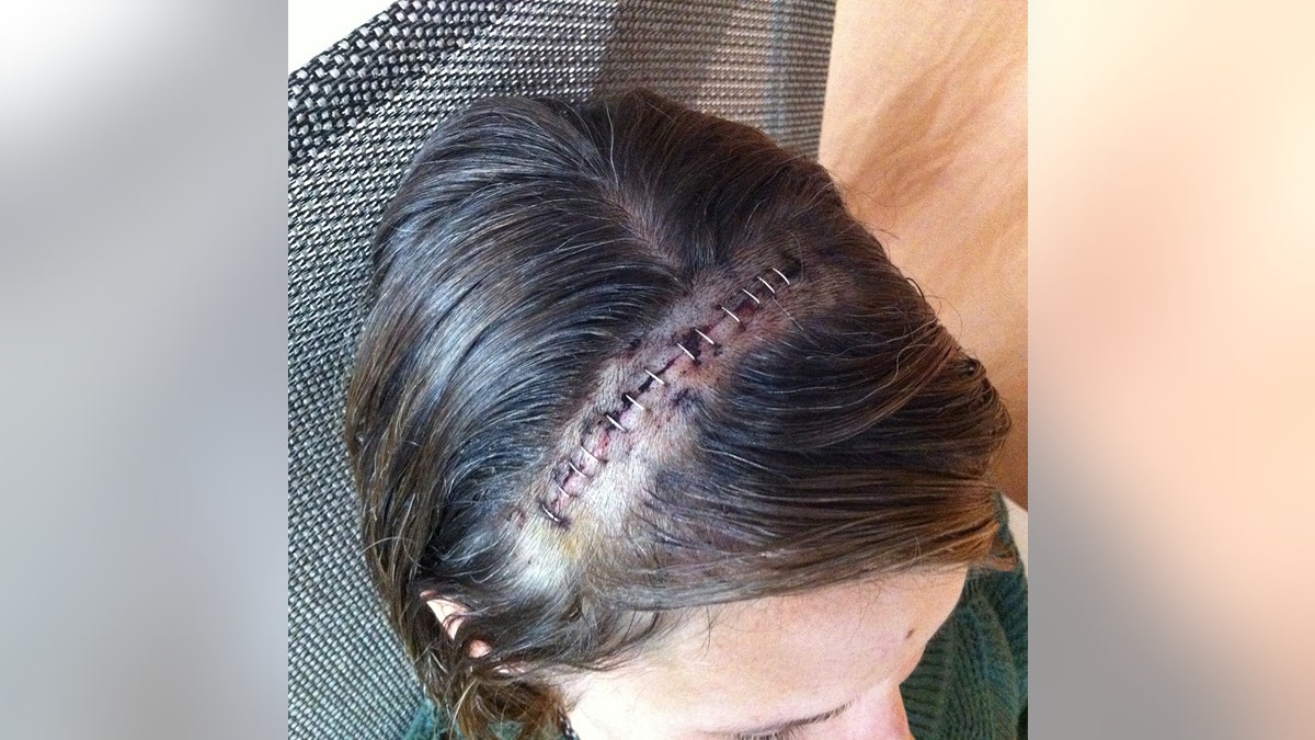 A close-up of Wendi Lou Lees stitches from brain surgery