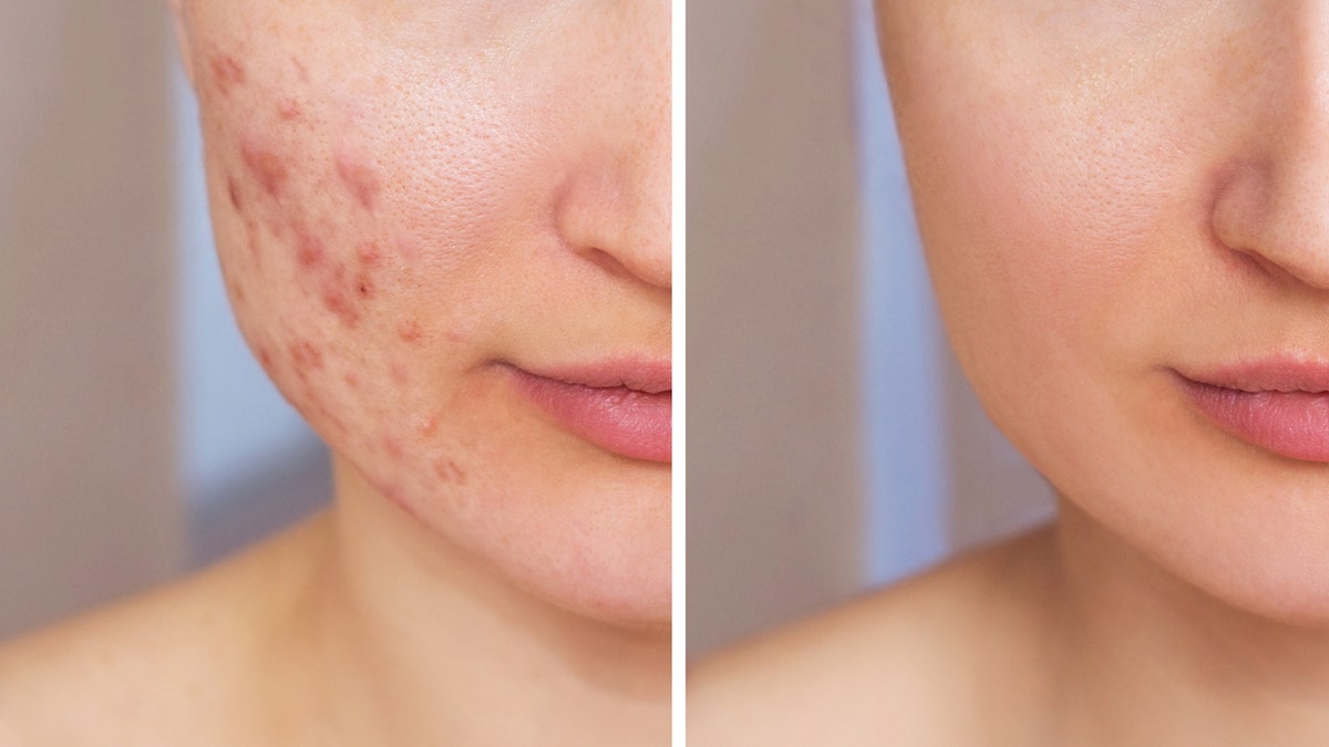 Side-by-side photo of woman with and without acne.