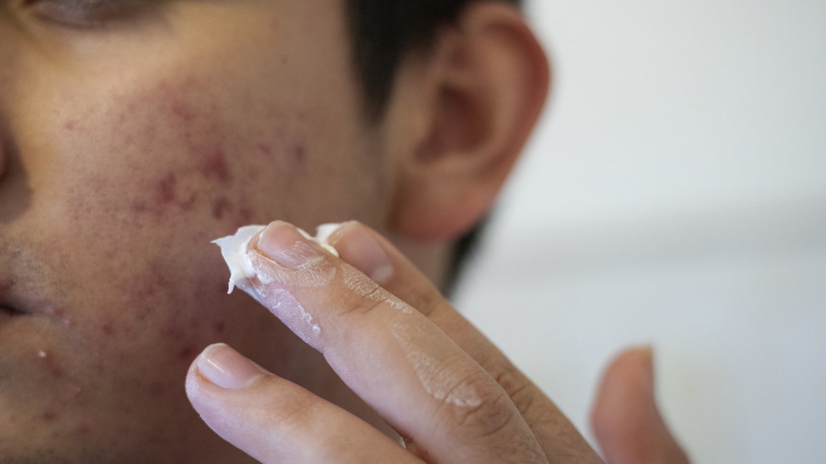 Man begins to apply paste to acne on cheek.