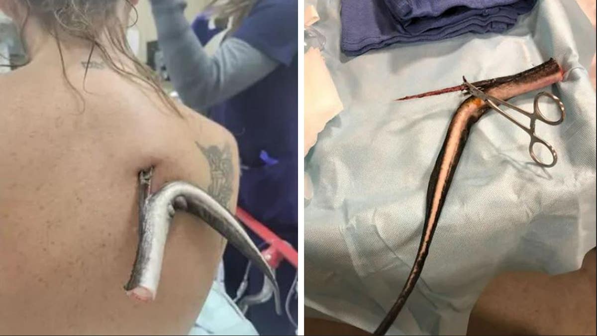 A photo showing the stingray barb in Kristie O'Brien's back