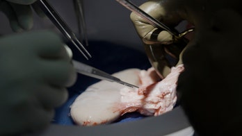 Pig kidney works in body of brain-dead man for over a month, a giant step in animal-human organ transplants