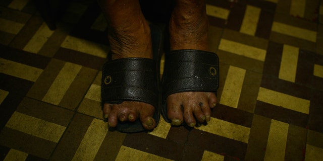 A Brazil man's feet show impacts of leprosy