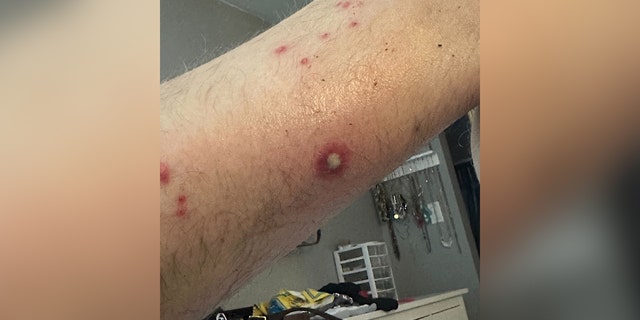 Close up of an arm with a rash
