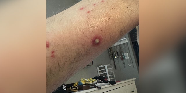 Close up of an arm with a rash