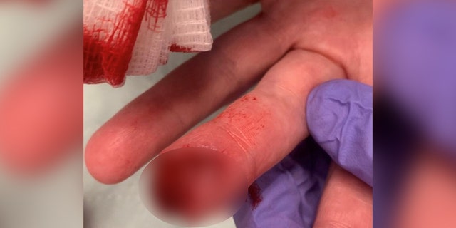 Heverly's bleeding finger
