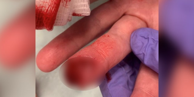 Heverly's bleeding finger