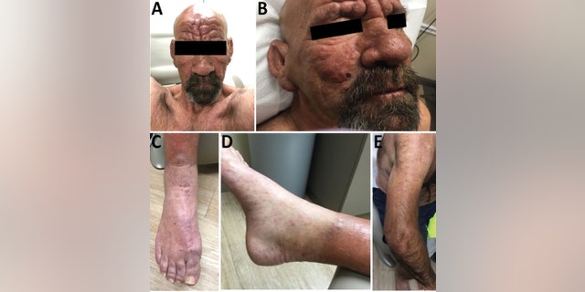 A central Florida man with leprosy