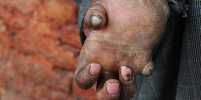 A leprosy patient holds out his hand in India