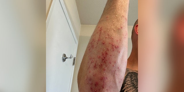 Man's arm covered in a rash