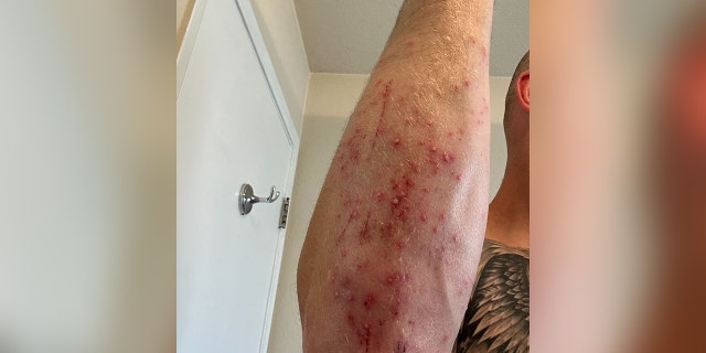 Man's arm covered in a rash