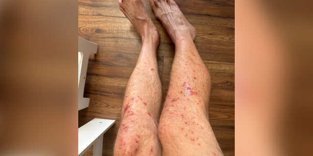 Man's legs covered in a rash