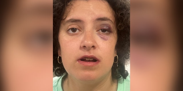 Rockville, Maryland victim with black eye