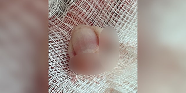 Haverly's severed fingertip