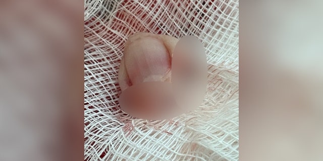 Haverly's severed fingertip