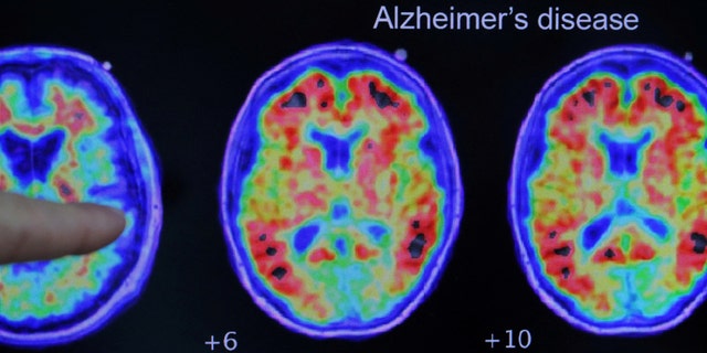 Alzheimer’s disease