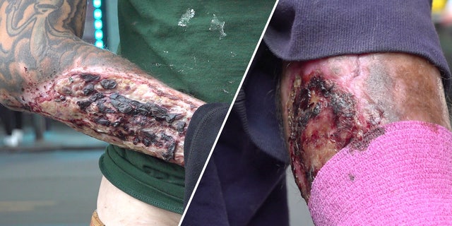 Drug users show their flesh-eating wounds