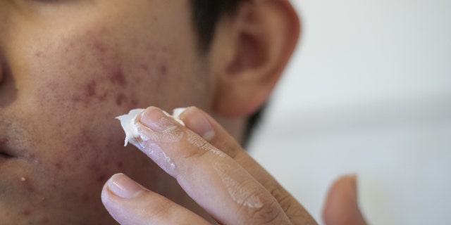 Man begins to apply paste to acne on cheek.