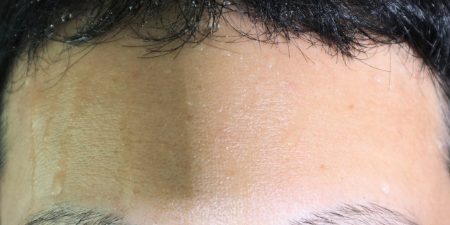 Close up of man's sweaty forehead.