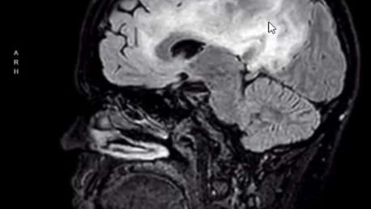 Tasha Kann brain scan