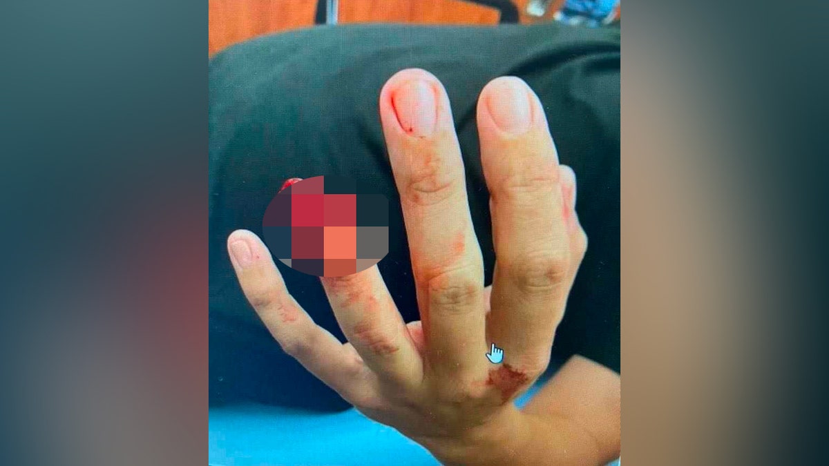 Bloody missing finger tip shown by man in hospital bed