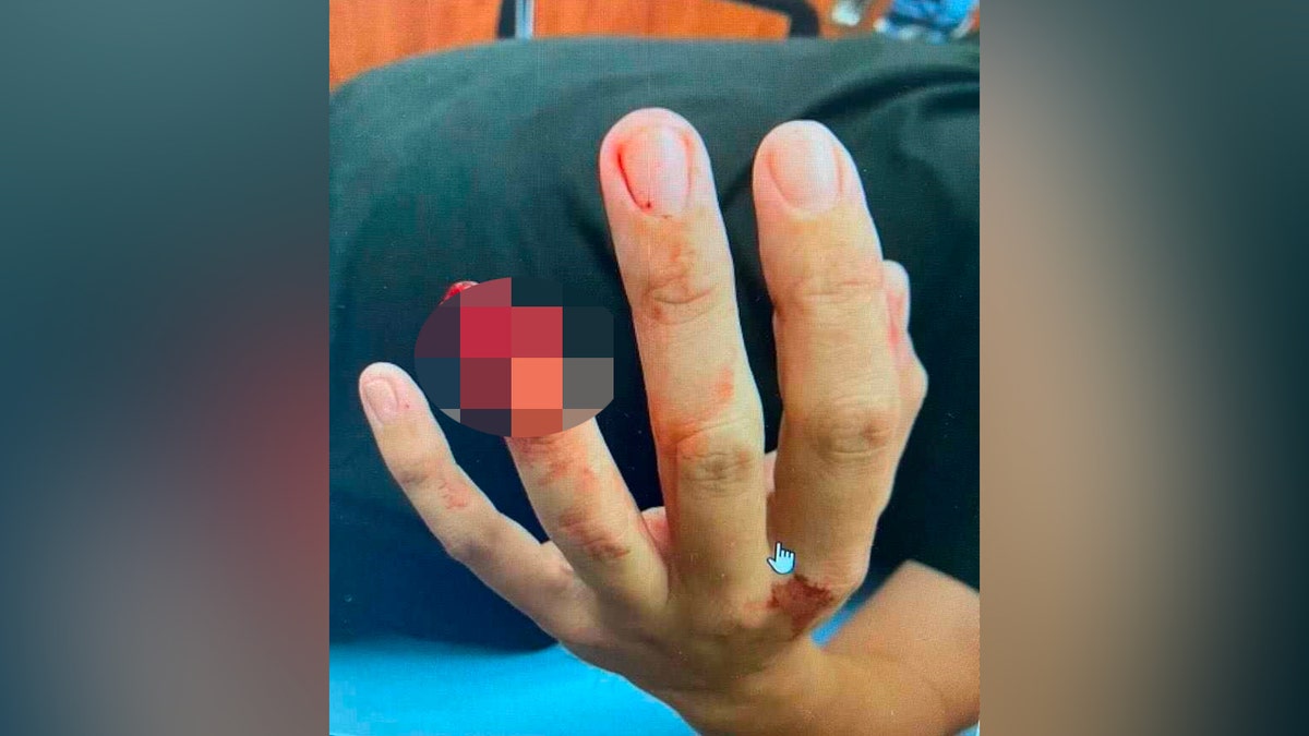 A missing bloody fingertip is shown by a man in a hospital bed