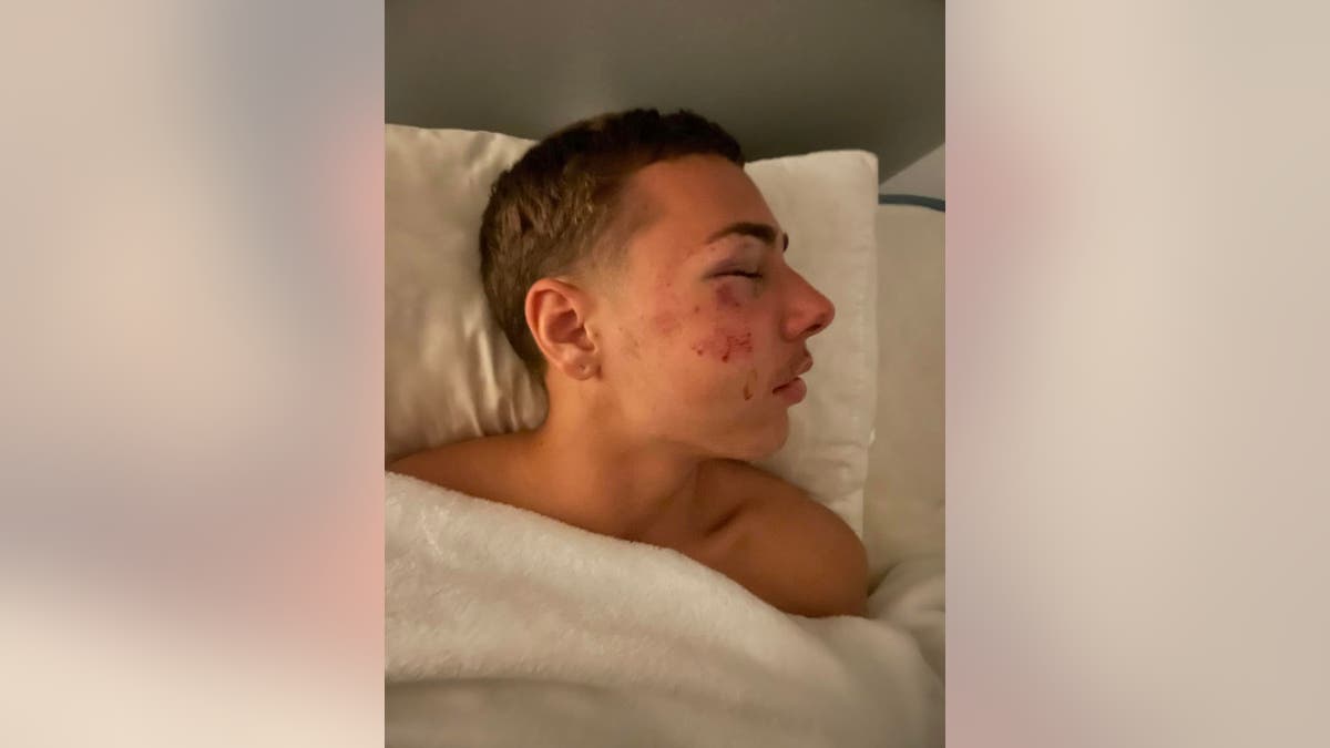 Injuries suffered by 15-year-old during state trooper's alleged assault