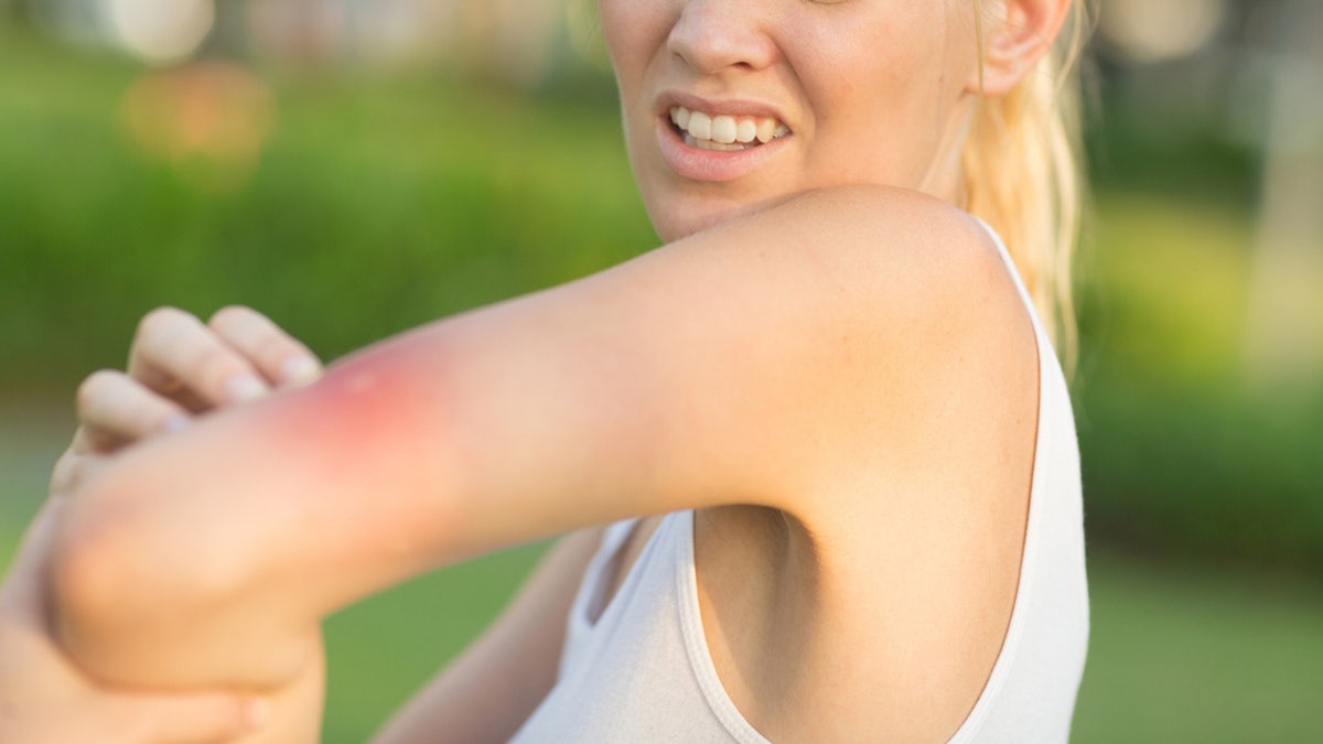woman scratching mosquito bite