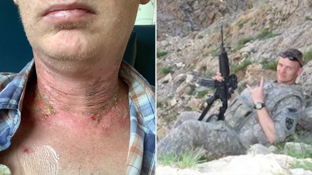 Left, Jonathan Tatom shows burn marks from radiation treatment on his neck, right, Jonathan Tatom in Army uniform holding rifle