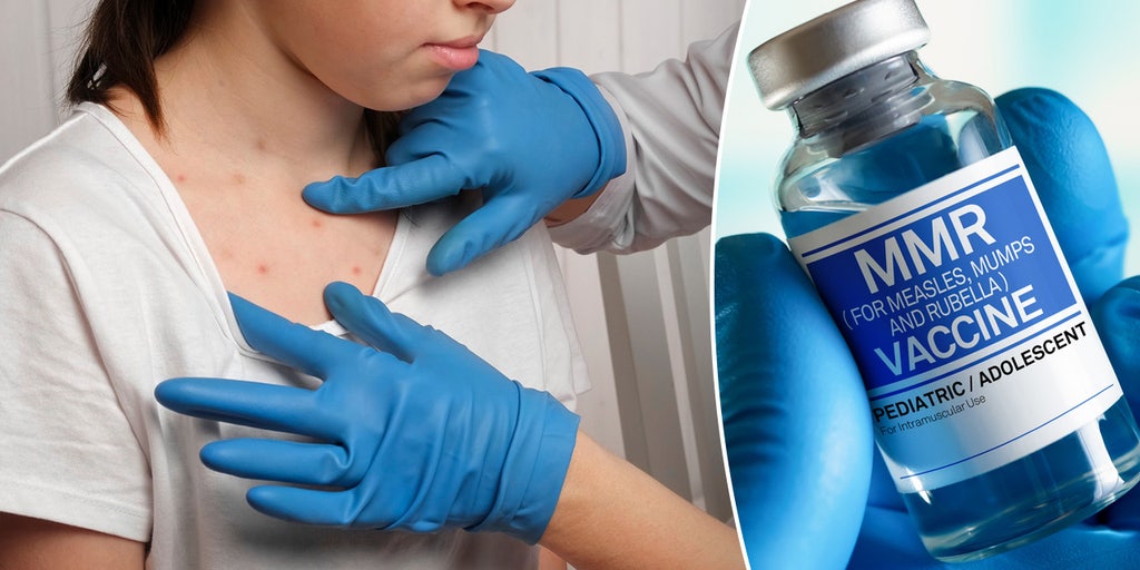 Illinois reports first measles case since 2019: 'One of the most contagious diseases known' - Vimarsana News