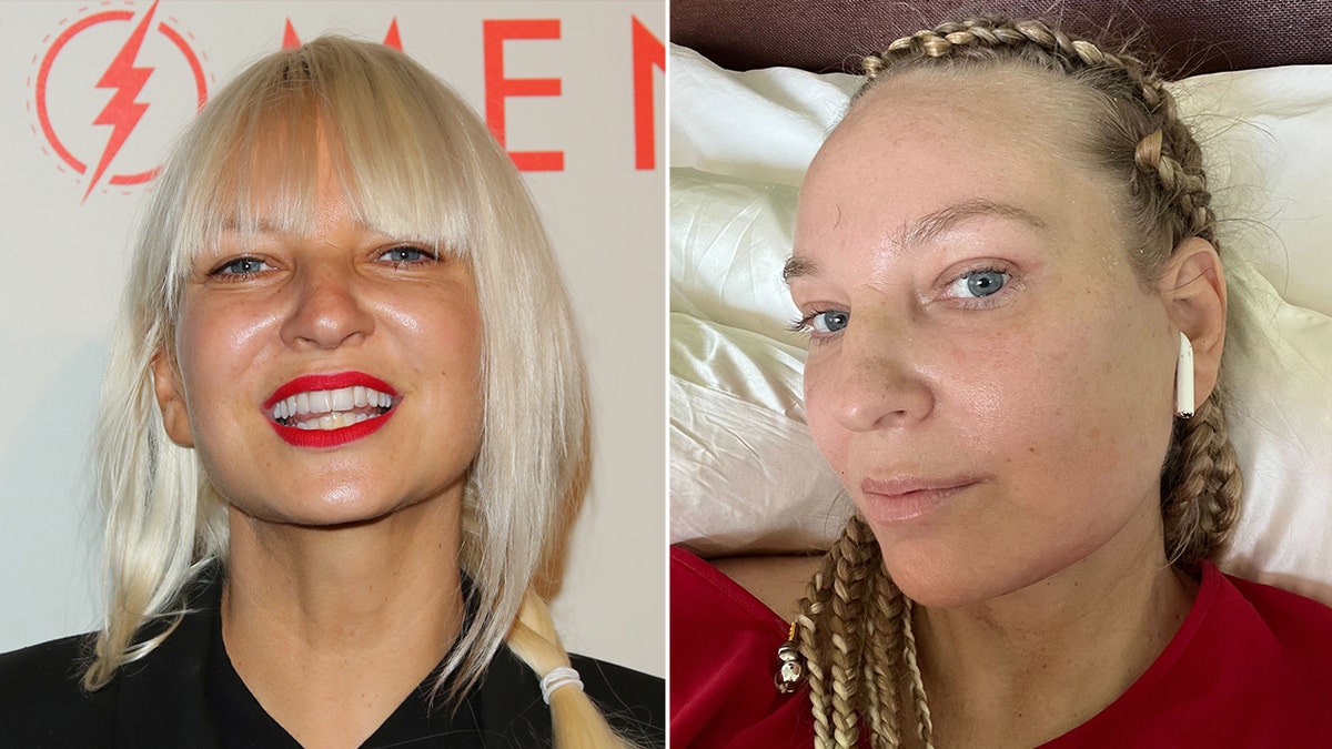 split screen of Sia before and after facelift