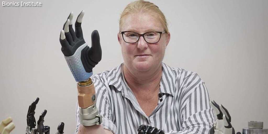 Meet the first person ever to receive a fully functional bionic hand with  AI