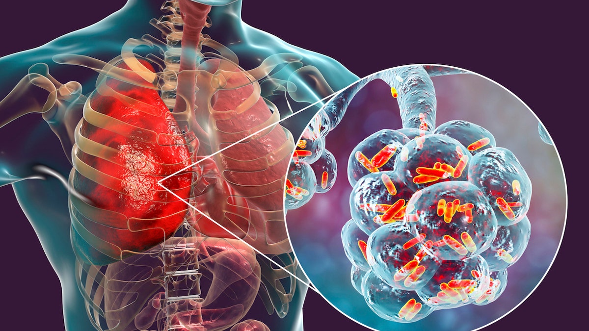 Bacterial pneumonia